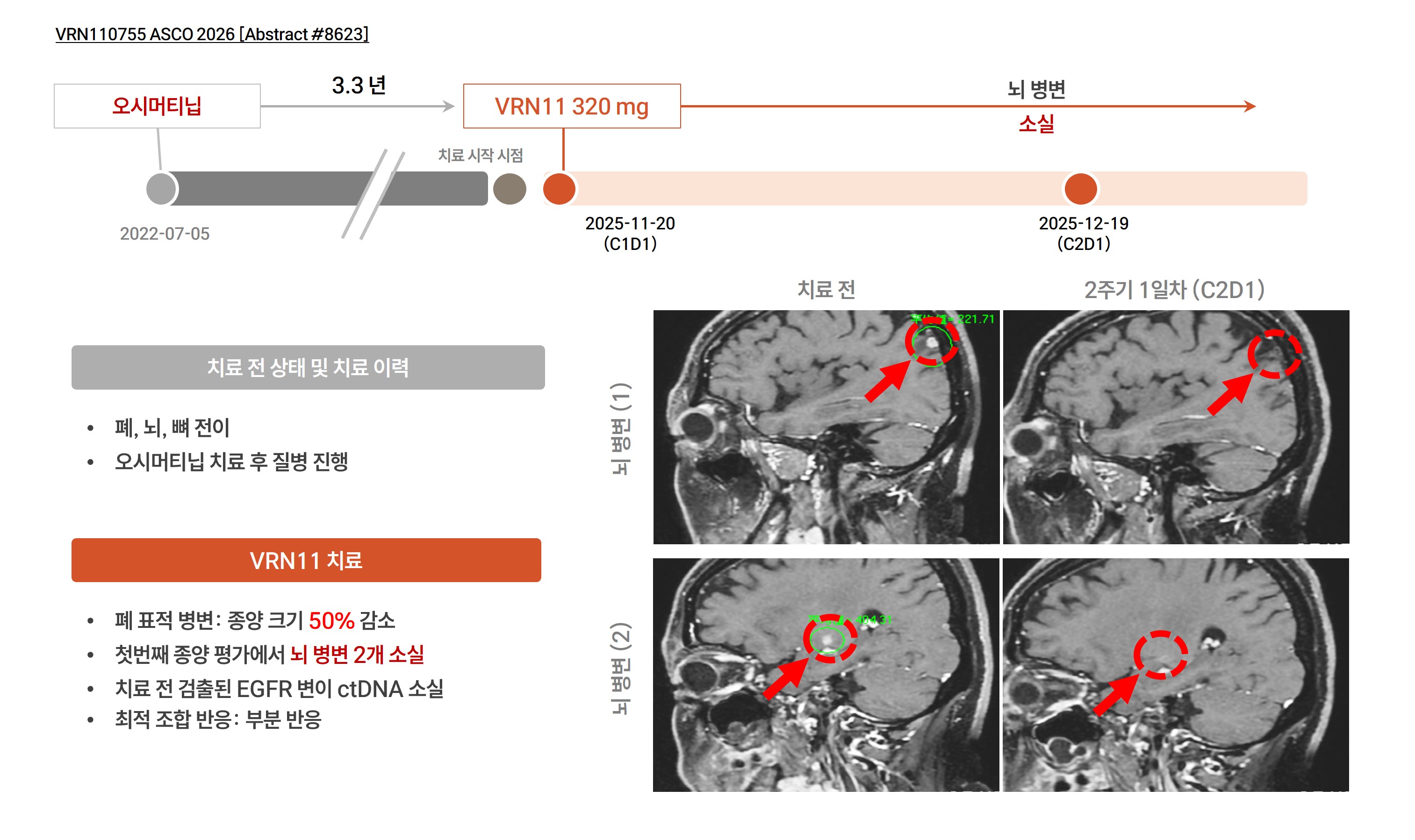 오시머티닙 치료 후 진행된 EGFR Del19/C797S 변이 환자의 VRN11 투여 전후 뇌 병변 MRI, 두 개의 뇌 병변 모두 소실