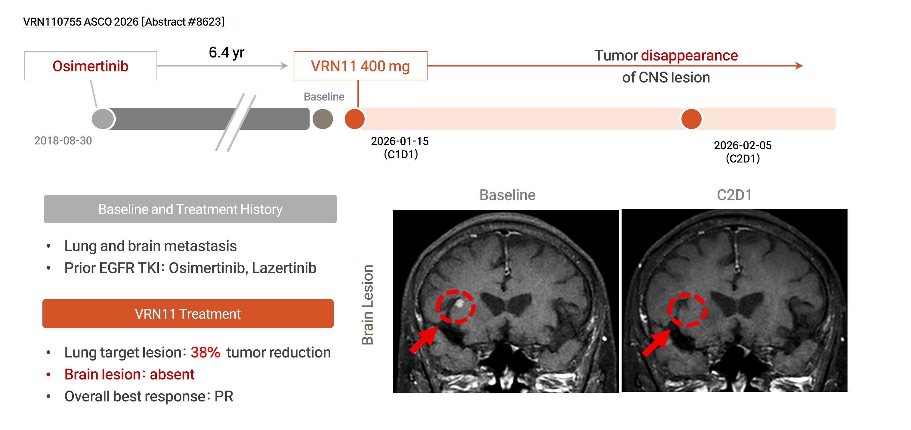 Brain MRI before and after VRN11 in a patient with EGFR L858R after prior third-generation EGFR therapy