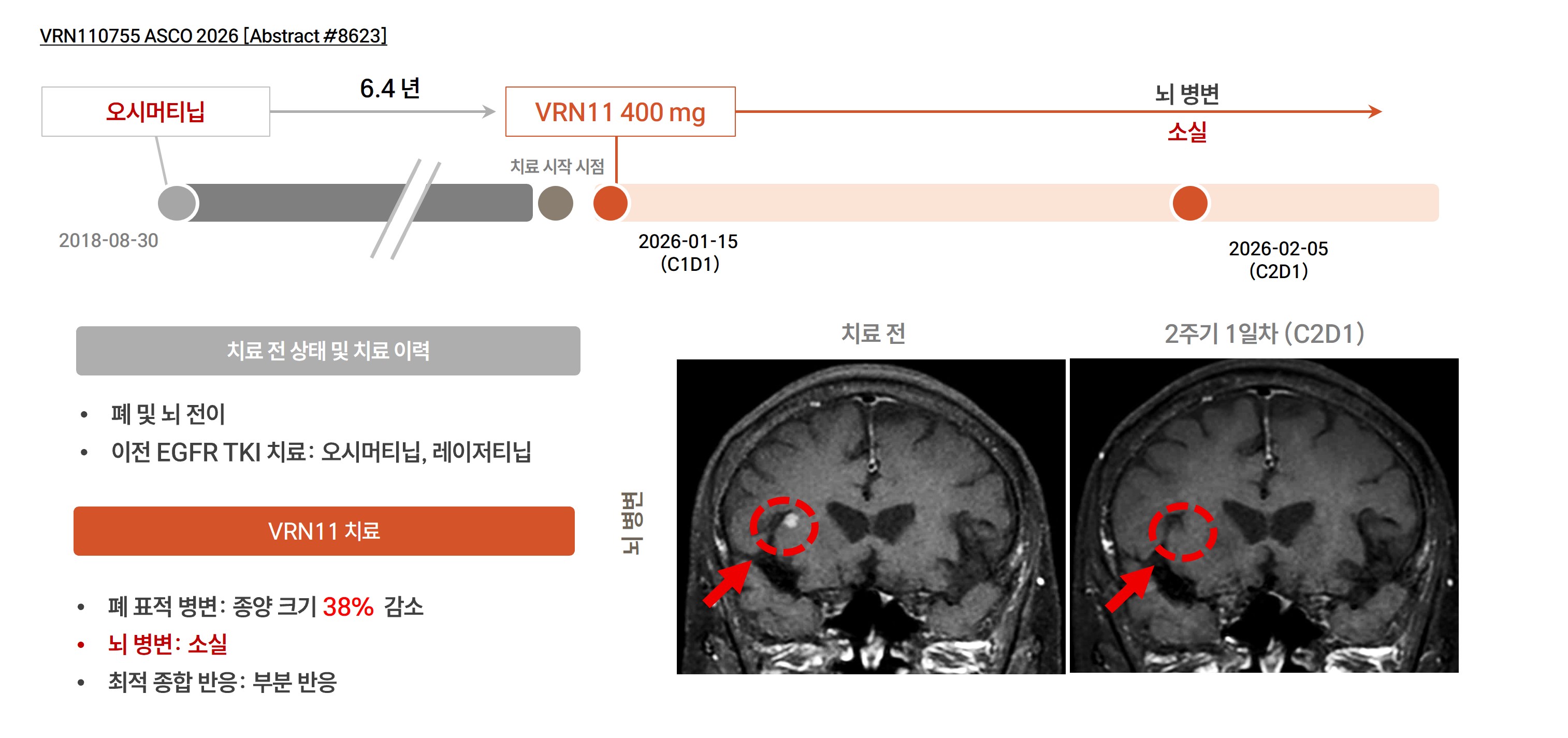 오시머티닙 및 레이저티닙 치료 후 진행된 EGFR L858R 변이 환자의 VRN11 투여 전후 뇌 병변 MRI, 뇌 병변 소실